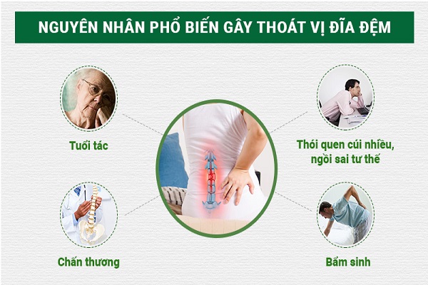 Muốn chữa được bệnh, cần phải biết nguyên nhân gây thoát vị đĩa đệm : Xương  Khớp Việt – 99% người bệnh áp dụng đã khỏi